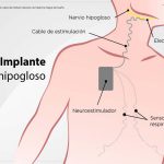 Implante de hipogloso: cirugía contra la apnea del sueño