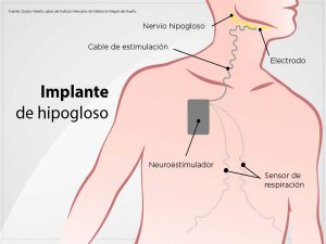 Implante de hipogloso: cirugía contra la apnea del sueño