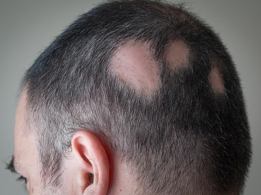 alopecia