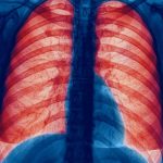 ¿Qué es la Enfermedad Pulmonar Obstructiva Crónica?