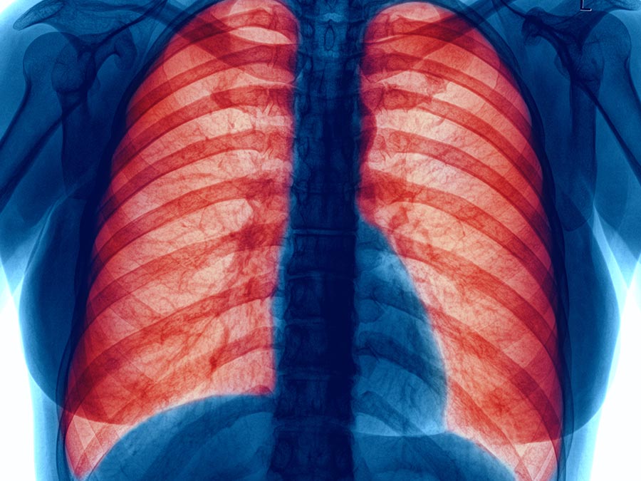 ¿Qué es la Enfermedad Pulmonar Obstructiva Crónica?