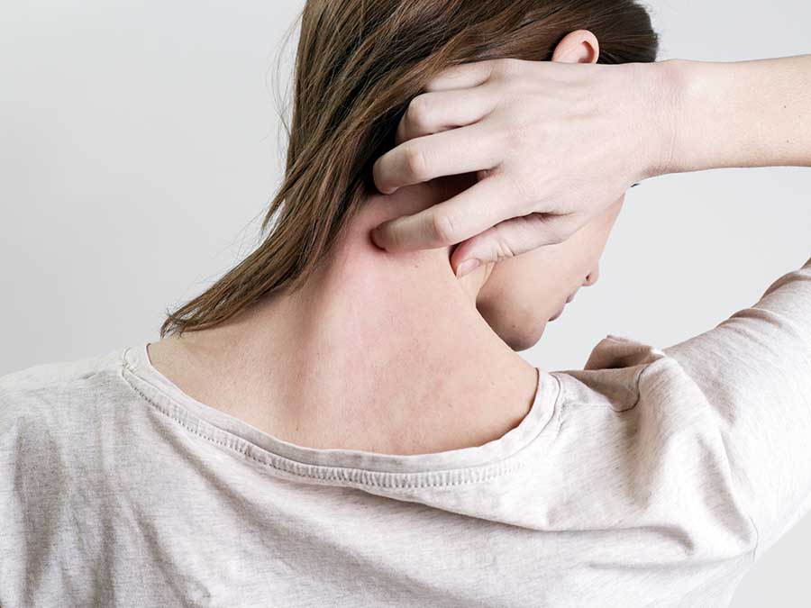 Dermatitis herpetiforme, signo de la intolerancia al gluten