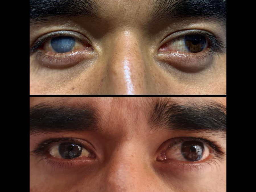 Tatuaje ocular, una alternativa para personas con ojo ciego